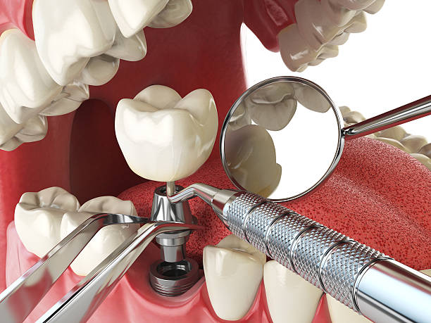 Best Knocked-Out Tooth Emergency  in Irving, TX